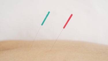 鍼治療と美容鍼